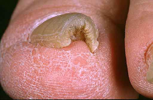 Картинка:41 distal subungual 49.jpg
