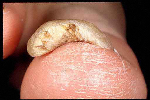 Картинка:41 distal subungual 12.jpg