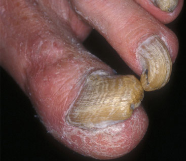 Картинка:Nail fungus.jpg